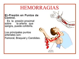 HEMORRAGIAS
B)-Presión en Puntos de
Control.
Es la presión proximal
sobre la arteria que
sangra, puede cohibirla.
Los principales puntos
arteriales son:
Femoral, Braquial y Carotideo.
ARTERIA
BRAQUIAL
 