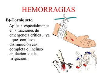 HEMORRAGIAS
B)-Torniquete.
Aplicar especialmente
en situaciones de
emergencia crítica , ya
que conlleva
disminución casi
completa e incluso
anulación de la
irrigación.
 