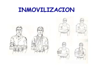 INMOVILIZACION
 