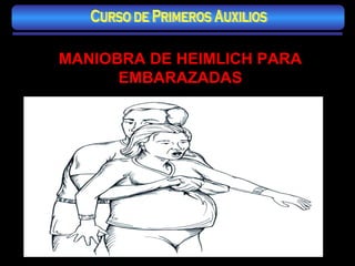 MANIOBRA DE HEIMLICH PARA EMBARAZADAS Curso de Primeros Auxilios 
