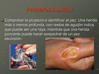 Primeros Auxilios
Comprobar la picadura e identificar al pez. Una herida
más o menos profunda, con restos de aguijón indica
que puede ser una raya, mientras que una herida
punzante puede hacer sospechar de un pez
escorpión.
 