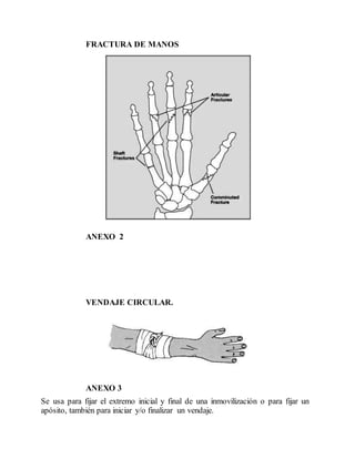 FRACTURA DE MANOS
ANEXO 2
VENDAJE CIRCULAR.
ANEXO 3
Se usa para fijar el extremo inicial y final de una inmovilización o para fijar un
apósito, también para iniciar y/o finalizar un vendaje.
 