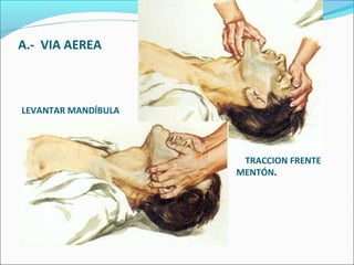 A.- VIA AEREA
LEVANTAR MANDÍBULA
TRACCION FRENTE
MENTÓN.
 