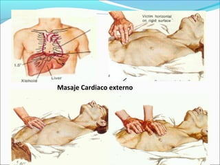 º
Masaje Cardiaco externo
 
