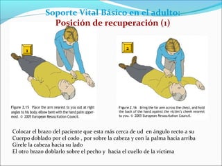 Soporte Vital Básico en el adulto:
Posición de recuperación (1)
1 2
Colocar el brazo del paciente que esta más cerca de ud en ángulo recto a su
Cuerpo doblado por el codo , por sobre la cabeza y con la palma hacia arriba
Gírele la cabeza hacia su lado
El otro brazo doblarlo sobre el pecho y hacia el cuello de la víctima
 