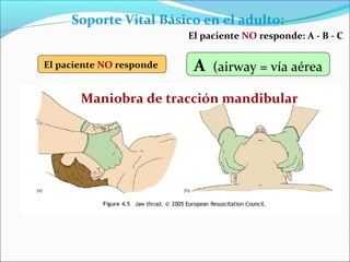 Soporte Vital Básico en el adulto:
Maniobra de tracción mandibular
El paciente NO responde A (airway = vía aérea
El paciente NO responde: A - B - C
 