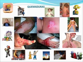 QUEMADURAS
 