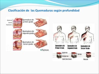 Clasificación de las Quemaduras según profundidad
 