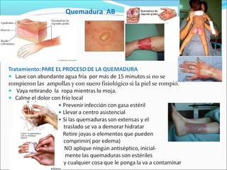 Quemadura AB
 