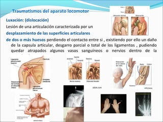 Traumatismos del aparato locomotor
Luxación: (dislocación)
Lesión de una articulación caracterizada por un
desplazamiento de las superficies articulares
de dos o más huesos perdiendo el contacto entre si , existiendo por ello un daño
de la capsula articular, desgarro parcial o total de los ligamentos , pudiendo
quedar atrapados algunos vasos sanguíneos o nervios dentro de la
articulación.
 