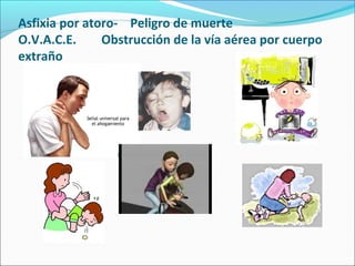 Asfixia por atoro- Peligro de muerte
O.V.A.C.E. Obstrucción de la vía aérea por cuerpo
extraño
 