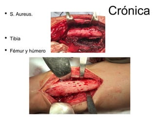 Crónica
• S. Aureus.
• Tibia
• Fémur y húmero
 