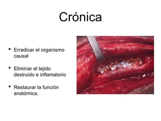 Crónica
• Erradicar el organismo
causal
• Eliminar el tejido
destruido e inflamatorio
• Restaurar la función
anatómica.
 