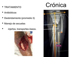 Crónica
• TRATAMIENTO
• Antibióticos
• Desbridamiento (promedio 3)
• Manejo de secuelas
• injertos, transportes óseos.
 