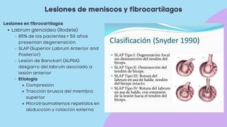 Lesiones de meniscos y fibrocartílagos
Labrum glenoideo (Rodete)
85% de los pacientes > 50 años
presentan degeneración.
SLAP (Superior Labrum Anterior and
Posterior)
Lesión de Banckart (ALPSA):
desgarro del labrum asociado a
lesión anterior
Etiología
Compresión
Tracción brusca del miembro
superior
Microtraumatismos repetidos en
abducción y rotación externa
Lesiones en fibrocartílagos
 