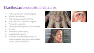 Manifestaciones extraarticulares
● Fiebre, cansancio y pérdida de peso.
● Nódulos reumatoides.
● Escleritis y queratoconjuntivitis.
● Ojos y boca seca (síndrome Sjogren).
● Pericarditis y pleuritis.
● Fibrosis pulmonar y nódulos pulmonares.
● Anemia.
● Amiloidosis (infrecuente).
● Vasculitis (infrecuente).
● Síndrome de Felty (infrecuente), con
esplenomegalia, leucopenia, adenopatía,
anemia y trombocitopenia.
 