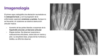 Imagenología
El primer signo radiográfico de afectación reumatoide es
la osteopenia local, y con la progresión de la
enfermedad, aparecen erosiones y quistes. Aunque no
es frecuente, en ocasiones se observa destrucción
articular masiva
- Aumento de las partes blandas a expensas de la
hipertrofia sinovial y el derrame articular
- Etapas tardías: Se observan luxaciones o
subluxaciones articulares, sobre todo en manos y
pies. La anquilosis ósea, propia de las muñecas y
tobillos, es difícil de observar.
 