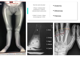 Nivel de radio densidad
• Mayor radiodensidad
(radiopacos) → Menor
radiodensidad (radiolucido)
• Metal → Hueso → Agua
(músculo/grasa) → Aire
• Anatomía
• Diferencias
• Patrones
 