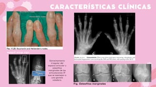 CARACTERÍSTICAS CLÍNICAS
Fig. Osteofitos marginales
seagull wings sign:
Estrechamiento
irregular del
espacio articular y
osteofitos
marginales de las
articulaciones IP
que se asemejan a
una gaviota
voladora.
 