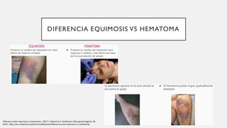 DIFERENCIA EQUIMOSIS VS HEMATOMA
Diferencia entre equimosis y hematoma. (2017.). Robalino,K. Slideshare.Recuperado Agosto 28,
2023. https://es.slideshare.net/KarolinaRobalino/diferencia-entre-equimosis-y-hematoma
 