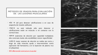 MÉTODOS DE IMAGEN PARA EVALUACIÓN
DE LAS LESIONES MUSCULARES
• •RX → útil para detectar calcificaciones o en caso de
sospecha de miositis osificante
• •TAC→ no está indicada sólo para detectar si
calcificaciones están en músculo o en contacto con la
cortical ósea
• •RM→ exámenes de elección por capacidad multiplanar,
alto contraste tisular, alta sensibilidad, menor especificidad
• •USG→ mejor examen de elección se realiza eje corto y
largo de cada músculo, ayuda a intervenciones como
aspiración del hematoma y en la inyección de plasma rico
en plaquetas)
• DX diferencial:contractura muscular
 