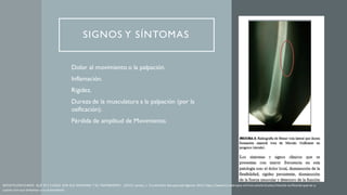 SIGNOS Y SÍNTOMAS
1. Dolor al movimiento o la palpación.
2. Inflamación.
3. Rigidez.
4. Dureza de la musculatura a la palpación (por la
osificación).
5. Pérdida de amplitud de Movimiento.
MIOSITIS OSIFICANTE. QUÉ ES Y CUÁLES SON SUS SÍNTOMAS Y SU TRATAMIENTO. (2015).Lamas, J. FisioOnline.Recuperado Agosto 2023. https://www.fisioterapia-online.com/articulos/miositis-osificante-que-es-y-
cuales-son-sus-sintomas-y-su-tratamiento
 