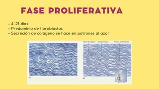 FASE PROLIFERATIVA
4-21 días
Predominio de fibroblastos
Secreción de colágeno se hace en patrones al azar
 