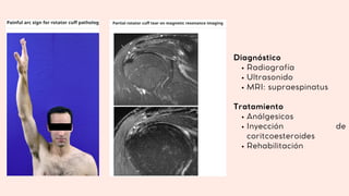 Radiografía
Ultrasonido
MRI: supraespinatus
Análgesicos
Inyección de
coritcoesteroides
Rehabilitación
Diagnóstico
Tratamiento
 