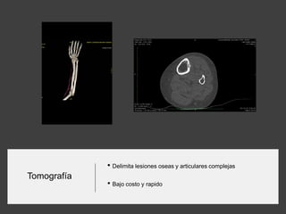 Tomografía
• Delimita lesiones oseas y articulares complejas
• Bajo costo y rapido
 