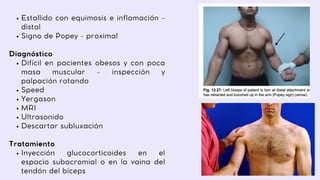 Estallido con equimosis e inflamación -
distal
Signo de Popey - proximal
Difícil en pacientes obesos y con poca
masa muscular - inspección y
palpación rotando
Speed
Yergason
MRI
Ultrasonido
Descartar subluxación
Inyección glucocorticoides en el
espacio subacromial o en la vaina del
tendón del bíceps
Diagnóstico
Tratamiento
 