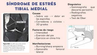 Sobre uso --> dolor en
las espinillas
Corredores y ciclistas -
30 grados
Intensidad
Eversión del pie
Ejercicio en clima frío
Burning/sharp empeora
Epicondilo femoral
lateral
Causas
Factores de riesgo
Manifestaciones
SÍNDROME DE ESTRÉS
TIBIAL MEDIAL
Gammagrafía que
descarte periostitis
Radiografías
negativas
Test de Ober
Diagnóstico
 