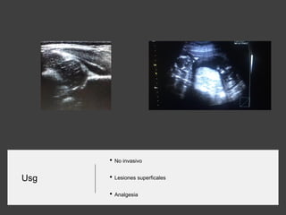 Usg
• No invasivo
• Lesiones superficales
• Analgesia
 