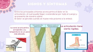 SIGNOS Y SÍNTOMAS
La articulación tiene
cierta rigidez.
Entre los principales síntomas se encuentra el dolor en la
articulación, el cual puede llegar a extenderse por todo el cuerpo y
se presenta de manera súbita.
El dolor se percibe cuando se mueve más próxima a la entesis
La zona se encuentra
enrojecida y su
temperatura es un poco
más elevada.
 