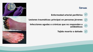 Enfermedad arterial periférica
Lesiones traumáticas: principal en personas jóvenes
Infecciones agudas o crónicas que no responden a
antibióticos
Tejido muerto o dañado
Causas
 