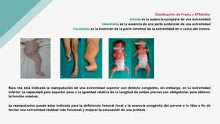 Rara vez está indicada la reamputación de una extremidad superior con defecto congénito, sin embargo, en la extremidad
inferior, la capacidad para soportar peso y la igualdad relativa de la longitud de ambas piernas son obligatorias para obtener
la función máxima.
La reamputación puede estar indicada para la deficiencia femoral focal y la ausencia congénita del peroné o la tibia a fin de
formar una extremidad residual más funcional y mejorar la colocación de una prótesis
Clasificación de Frantz y O’Rahilly:
Amelia es la ausencia completa de una extremidad
Hemimelia es la ausencia de una parte sustancial de una extremidad
Focomelia es la inserción de la parte terminal de la extremidad en o cerca del tronco.
 