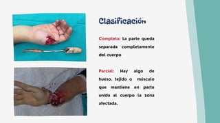 Clasificación
Completa: La parte queda
separada completamente
del cuerpo
Parcial: Hay algo de
hueso, tejido o músculo
que mantiene en parte
unida al cuerpo la zona
afectada.
 