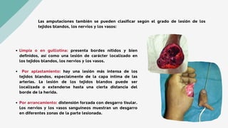 Limpia o en guillotina: presenta bordes nítidos y bien
definidos, así como una lesión de carácter localizado en
los tejidos blandos, los nervios y los vasos.
Por aplastamiento: hay una lesión más intensa de los
tejidos blandos, especialmente de la capa íntima de las
arterias. La lesión de los tejidos blandos puede ser
localizada o extenderse hasta una cierta distancia del
borde de la herida.
Por arrancamiento: distensión forzada con desgarro tisular.
Los nervios y los vasos sanguíneos muestran un desgarro
en diferentes zonas de la parte lesionada.
Las amputaciones también se pueden clasificar según el grado de lesión de los
tejidos blandos, los nervios y los vasos:
 