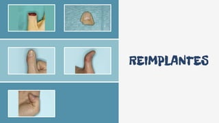 REIMPLANTES
 