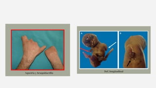 Aqueiria y braquidactilia
Def. longitudinal
 