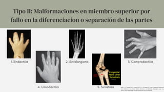 Sindactilia
1.
Tipo II: Malformaciones en miembro superior por
fallo en la diferenciacion o separación de las partes
2. Sinfalangismo 3. Camptodactilia
4. Clinodactilia 5. Sinostosis RUIZ, C. A. V., MARINA, D. P., VÁZQUEZ-VELA, C. C., & LEEDER, P. C. (2012). ANOMALÍAS CONGÉNITAS
MÁS COMUNES DE LA MANO. REVISTA MEXICANA DE ORTOPEDIA PEDIÁTRICA, 14(1), 5-11.
HTTPS://WWW.MEDIGRAPHIC.COM/PDFS/OPEDIATRIA/OP-2012/OP121B.PDF
 