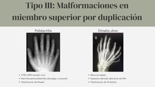 Tipo III: Malformaciones en
miembro superior por duplicación
Polidactilia Dimelia ulnar
1:700-1,000 nacidos vivos
Mas frecuente polidactilia del pulgar o preaxial
Clasificación de Wassel
Mano en espejo
Expresión elevada aberrante de SHH
Clasificación de Al-Qattan
 
