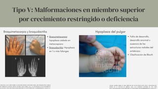 Tipo V: Malformaciones en miembro superior
por crecimiento restringido o deficiencia
CARLOS RAÚL, SANTA MARÍA-RAMIREZ, & LEGUIZAMÓN MENDOZA, DEYSI MARÍA GLORIA. (2018). BRAQUIDACTILIA FAMILIAR
SIN COMPONENTE FUNCIONAL. REVISTA CIENTÍFICA CIENCIA MÉDICA, 21(2), 75-76. RECUPERADO EN 04 DE SEPTIEMBRE DE
2023, DE HTTP://WWW.SCIELO.ORG.BO/SCIELO.PHP?SCRIPT=SCI_ARTTEXT&PID=S1817-74332018000200014&LNG=ES&TLNG=ES.
Braquimetacarpia y braquidactilia Hipoplasia del pulgar
VERGARA AMADOR, ENRIQUE M. (2008). HIPOPLASIA DEL PULGAR: PRESENTACIÓN CLÍNICA Y RECONSTRUCCIÓN.
REVISTA DE LA FACULTAD DE MEDICINA, 56(1), 33-42. RETRIEVED SEPTEMBER 04, 2023, FROM
HTTP://WWW.SCIELO.ORG.CO/SCIELO.PHP?SCRIPT=SCI_ARTTEXT&PID=S0120-00112008000100005&LNG=EN&TLNG=ES.
Braquimetacarpia:
hipoplasia aislada en
metacrapiano
Braquidactilia: Hipoplasia
en 1 o más falanges
Falta de desarrollo,
desarrollo anormal o
ausencia de las
estructuras radiales del
antebrazo.
Clasificación de Blauth
 