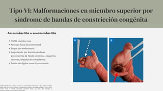 Tipo VI: Malformaciones en miembro superior por
síndrome de bandas de constricción congénita
SARMIENTO-OSORIO, DIANA CAROLINA, GUILLÉN OLAYA, JAVIER FABRICIO, FRANCO ZULUAGA, JORGE ANDRÉS, & GUTIÉRREZ
GÓMEZ, MARÍA LUCÍA. (2020). MANUAL DE MALFORMACIONES CONGÉNITAS DE MIEMBRO SUPERIOR EN FETOS O RECIÉN
NACIDOS BASADO EN ESTUDIOS CADAVÉRICOS. UNIVERSITAS MEDICA, 61(4), 88-106. EPUB SEPTEMBER 30,
2020.HTTPS://DOI.ORG/10.11144/JAVERIANA.UMED61-4.MMCM
Acrosindactilia o seudosindactilia
1:1200 nacidos vivos
Necrosis focal de extremidad
Etapa pos embrionaria
Amputación por bandas anulares
provenientes de tejido coriónico... isquemia,
necrosis, amputación intrauterina.
Fusión de dígitos como cicatrización.
 
