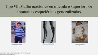 Acondroplasia Discondroplaisa Artrogriposis
Tipo VII: Malformaciones en miembro superior por
anomalias esqueléticas generalizadas
SARMIENTO-OSORIO, DIANA CAROLINA, GUILLÉN OLAYA, JAVIER FABRICIO, FRANCO ZULUAGA, JORGE ANDRÉS, & GUTIÉRREZ
GÓMEZ, MARÍA LUCÍA. (2020). MANUAL DE MALFORMACIONES CONGÉNITAS DE MIEMBRO SUPERIOR EN FETOS O RECIÉN
NACIDOS BASADO EN ESTUDIOS CADAVÉRICOS. UNIVERSITAS MEDICA, 61(4), 88-106. EPUB SEPTEMBER 30,
2020.HTTPS://DOI.ORG/10.11144/JAVERIANA.UMED61-4.MMCM
 