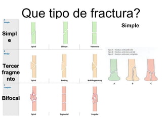 Que tipo de fractura?
Simple
Simpl
e
Tercer
fragme
nto
Bifocal
 