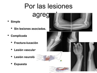Por las lesiones
agregadas
• Simple
• Sin lesiones asociadas.
• Complicada
• Fractura-luxación
• Lesión vascular
• Lesión neurológica
• Expuesta
 
