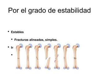 Por el grado de estabilidad
• Estables
• Fracturas alineadas, simples.
• Inestables
• Conminutas, varios fragmentos, desplazadas.
 