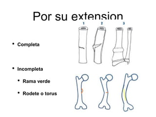 Por su extension
• Completa
• Incompleta
• Rama verde
• Rodete o torus
 