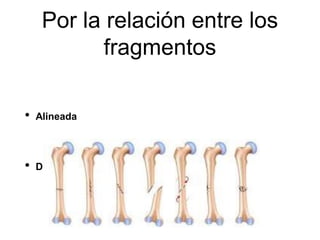 Por la relación entre los
fragmentos
• Alineada
• Desplazada
 