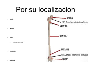 Por su localizacion
• Epífisis
• Metafisis
• Diáfisis
• Proximal, medio, distal
• Combinadas
• Especificas
 